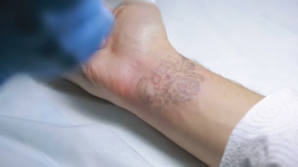 Laser tattoo removal with hand — Stock Video