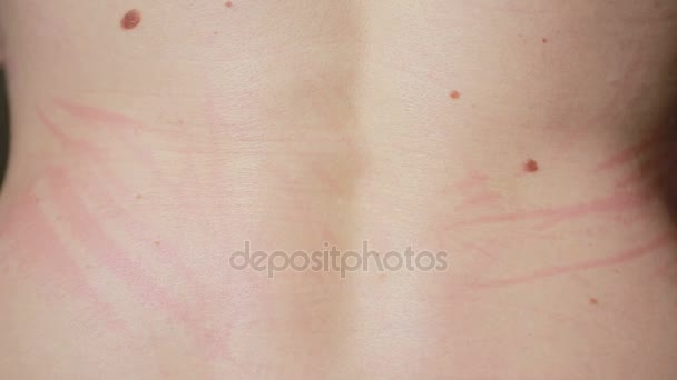 Hiperemia. una reacción alérgica al cuerpo. urticaria. manchas rojas en el cuerpo — Vídeo de stock