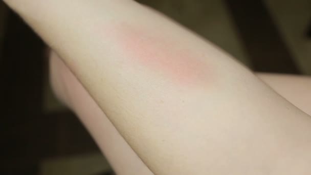 Hiperemia. una reacción alérgica al cuerpo. urticaria. manchas rojas en el cuerpo — Vídeos de Stock