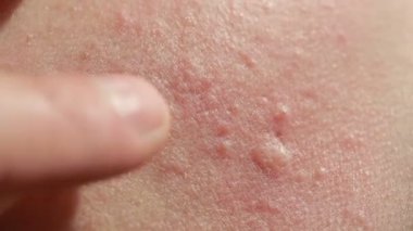 küresel Kistik akne cilt üzerinde. Yakın çekim. Dermatoloji kavramı
