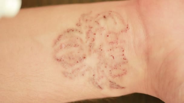 Laser tattoo αφαίρεση έννοια. ουλές μετά από τη διαδικασία αφαίρεσης. κοντινό πλάνο — Αρχείο Βίντεο
