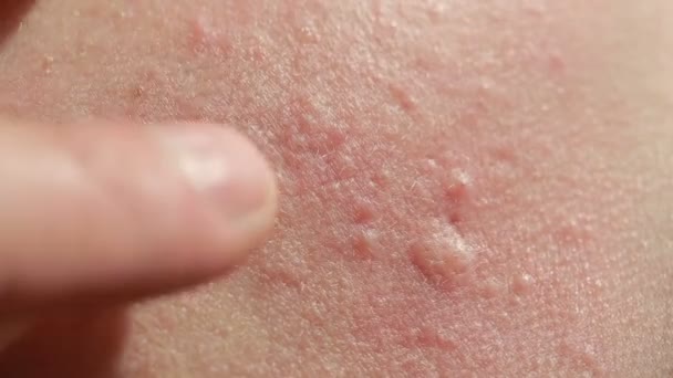 Spherical cystic acne on the skin. Close-up. The concept of dermatology — Stock Video