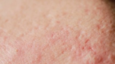 küresel Kistik akne cilt üzerinde. Yakın çekim. Dermatoloji kavramı