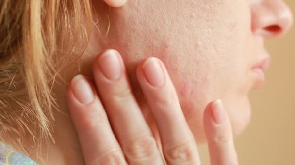 Sferische cystic acne op de huid. Close-up. Het concept van de dermatologie — Stockvideo