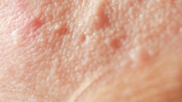 Sferische cystic acne op de huid. Close-up. Het concept van de dermatologie — Stockvideo