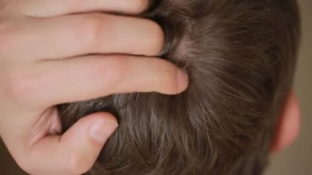 Vlasy lupy na muže, closeup, člověk škrábe hlavu. — Stock video