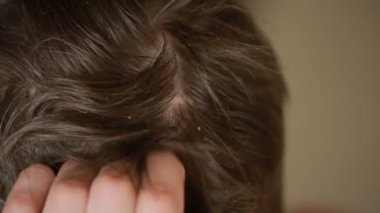 kepek saç erkekler, closeup, Tarih adam başını çizikler..