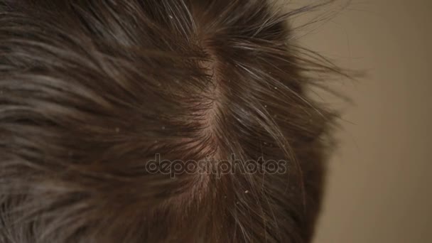 Dandruff hair on men, closeup, man scratches his head. — Stock Video