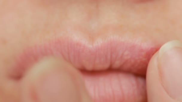 Menina tocando feridas nos lábios. herpes. tratamento labial — Vídeo de Stock