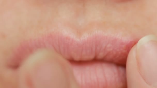 Mädchen berührt Wunden an den Lippen. Herpes. Lippenbehandlung — Stockvideo