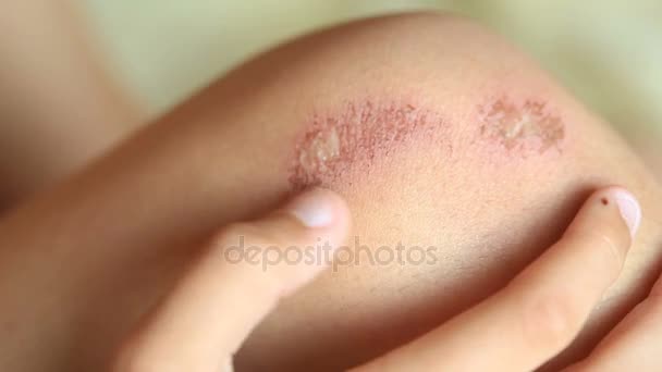 Wounded knee of the child, abrasions on the boys lap. close-up — Stock Video