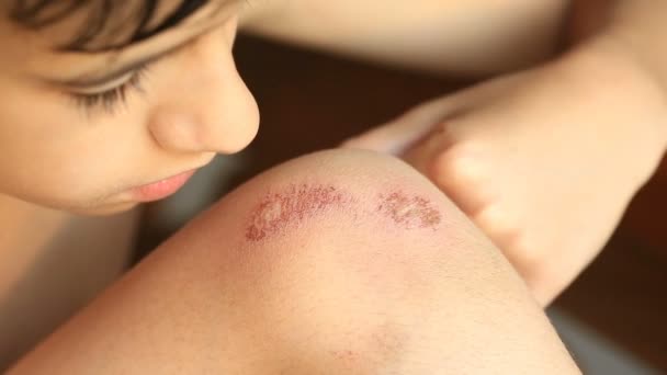 Wounded knee van het kind, schaafwonden op de schoot van de jongens. Close-up — Stockvideo