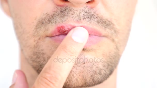 Man touching sores on the lips. herpes. lip treatment — Stock Video