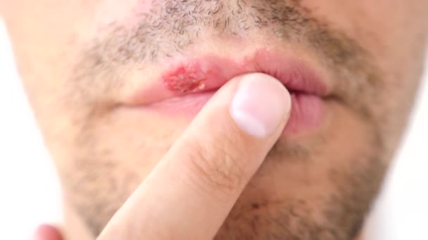 Hombre tocando llagas en los labios. herpes. tratamiento labial — Vídeos de Stock