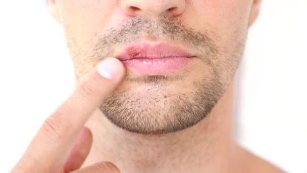 Чоловік торкається виразок на губах. герпес. лікування губ — стокове відео