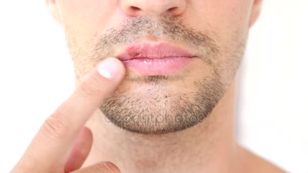 Hombre tocando llagas en los labios. herpes. tratamiento labial — Vídeos de Stock