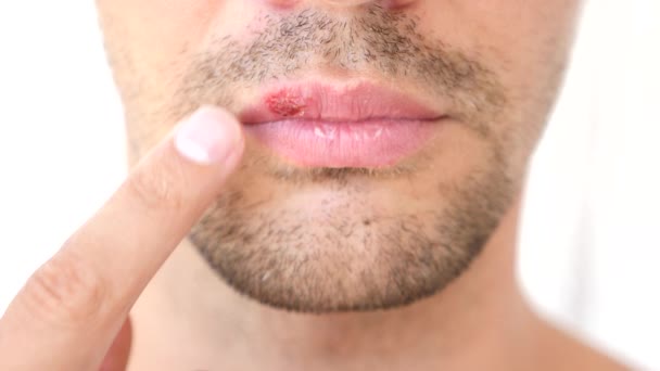 Homem tocando feridas nos lábios. herpes. tratamento labial — Vídeo de Stock