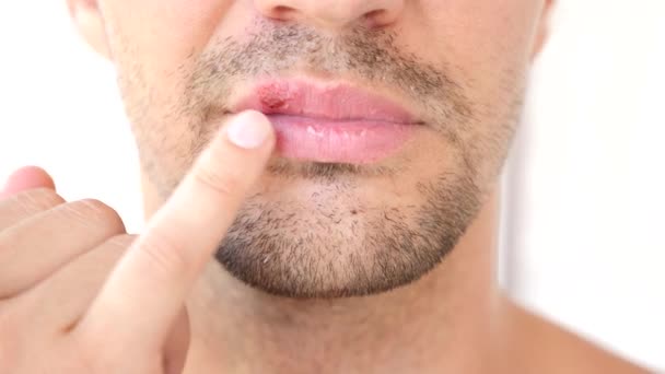 Hombre tocando llagas en los labios. herpes. tratamiento labial — Vídeos de Stock