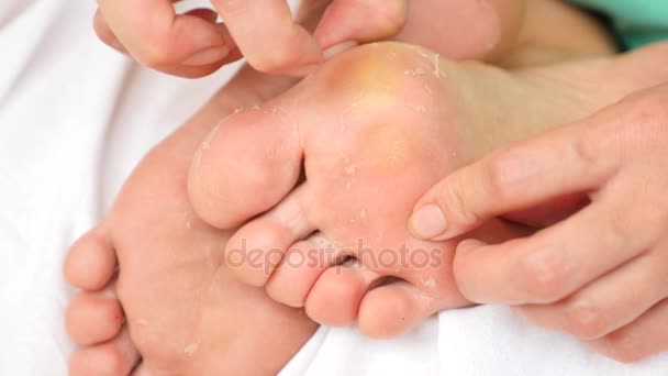 Kvinnliga fötter med hudavflagning. Foot peeling efter ingreppet. 4 k. slowmotion — Stockvideo
