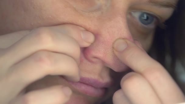 De vrouw de samendrukking van de acne, knijpt uit puistjes voor de spiegel. Close-up, 4k — Stockvideo