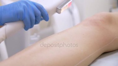 lazer epilasyon. Doktor eldiven. 4 k, yavaş hareket, yakın çekim.