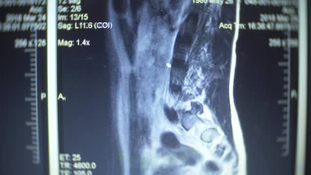 Perto. Imagens de raios-X por RM. resultados da terapia de ressonância magnética na tela do computador. 4k, borrando os limites do quadro . — Vídeo de Stock