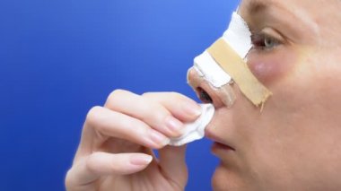 Rhinoplasti 'den sonraki ikinci günde bir kadın yüzü. Burunda bandaj, yüzünde şişlik ve morarma var.