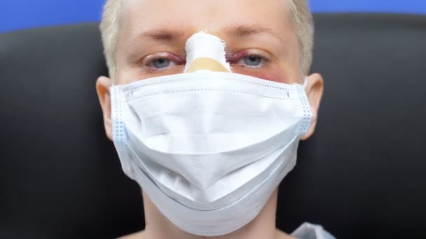 Paciente feminina após rinoplastia leva máscara facial médica. sangue, inchaço — Vídeo de Stock