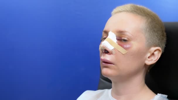 Primer plano de una cara femenina en el segundo día después de la rinoplastia. vendaje — Vídeo de stock