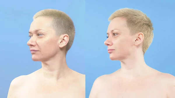 Porträt einer Frau. Vergleich vor und nach der Nasenkorrektur — Stockfoto