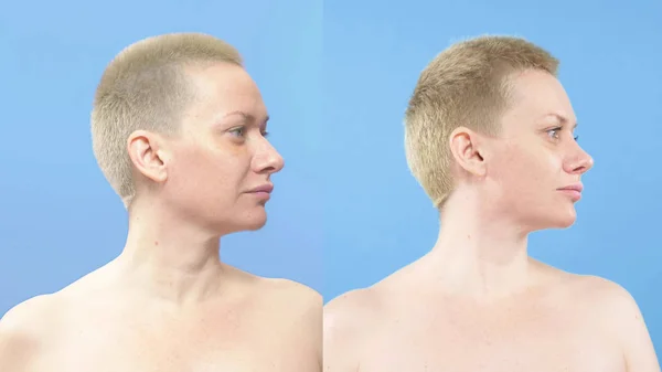 Retrato de uma mulher. comparação antes e depois da rinoplastia — Fotografia de Stock