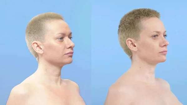 Retrato de una mujer. comparación antes y después de la rinoplastia —  Fotos de Stock