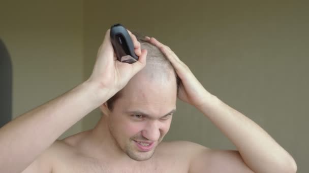 Hemma rakar en man sin skalliga fläck framför en spegel. håravfall problem — Stockvideo