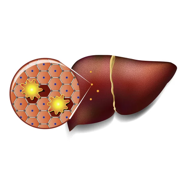Liver Cells Attacked by Toxins — Stock Vector