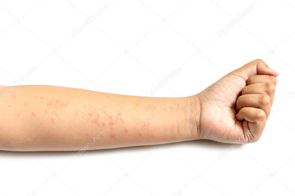 People getting red rash on the arm skin isolated on white background. Skin care concept