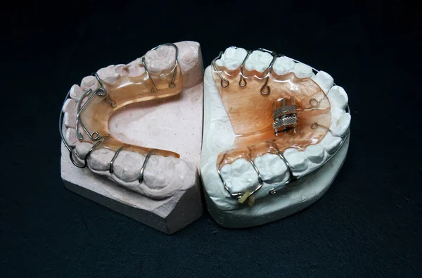 Dental Office Detail View Orthodontic Plaster Models — Stock Photo, Image