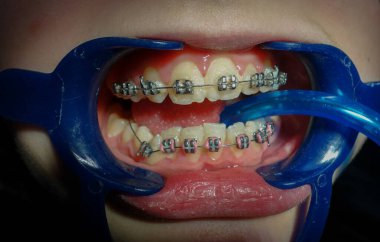 Patient in dental office with orthodontic brackets, elastics, bands during orthodontic treatment with dental fixed appliance