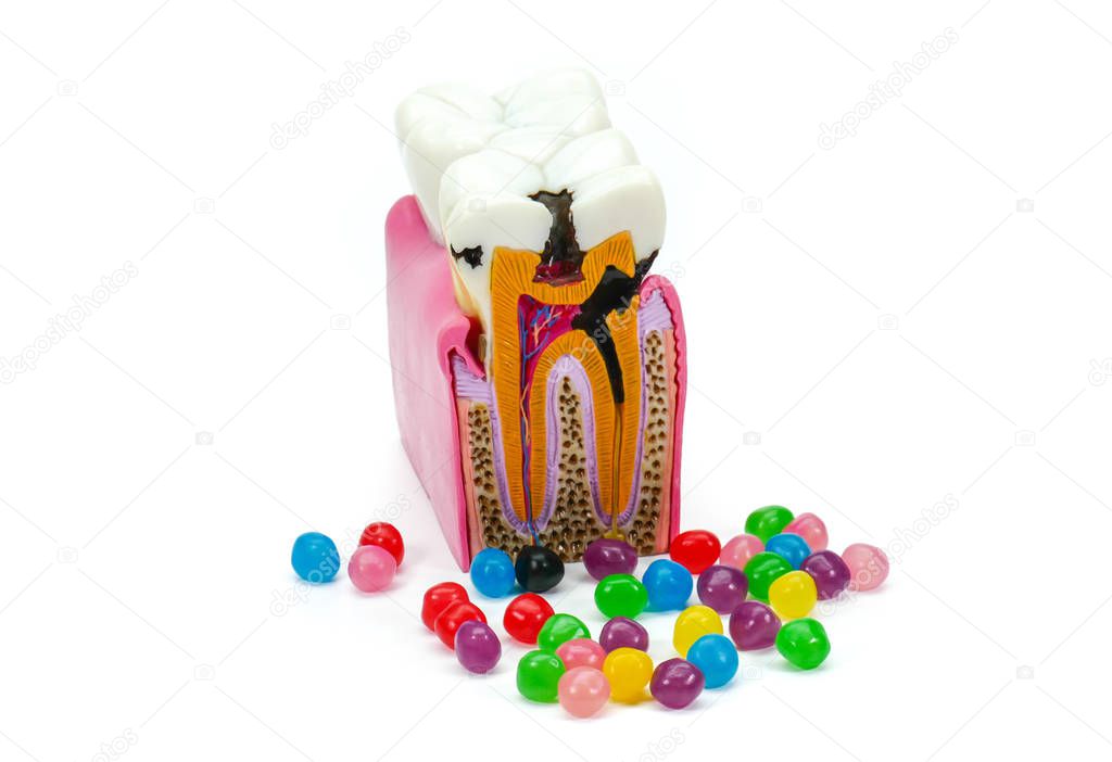 Concept of over-consumption, excessive candies, sugar consumption and dental diseases, caries, cavities. Tooth model with dental caries, abscesses surrounded by candies, sweets