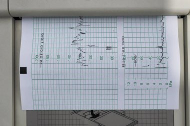 cardiotocography (ctg) doğum öncesi muayene