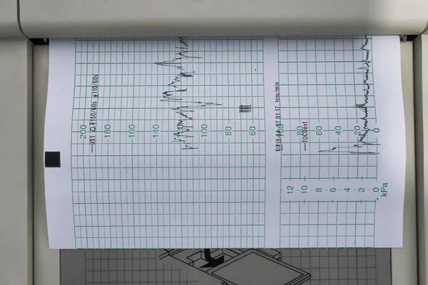 Cardiotocography (ctg) prenatális vizsgálat Stock Fotó