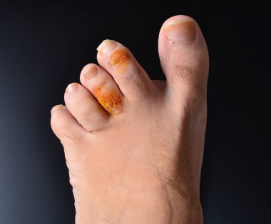 İnsan ayağının bir kısmında artrit ve artrosit var.