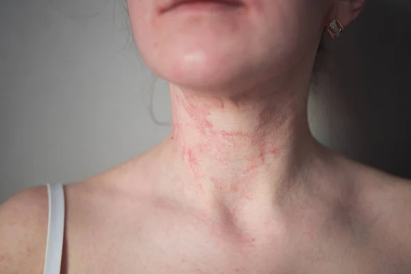 Das Mädchen Hat Dermatitis Hals Auf Grauem Hintergrund — Stockfoto