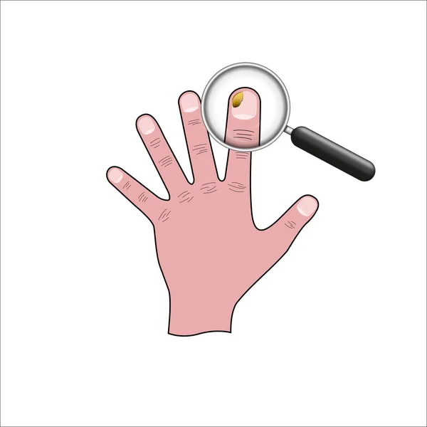 Champignon des ongles illustration médicale, main humaine avec loupe grossissant doigt affecté champignon des ongles — Image vectorielle