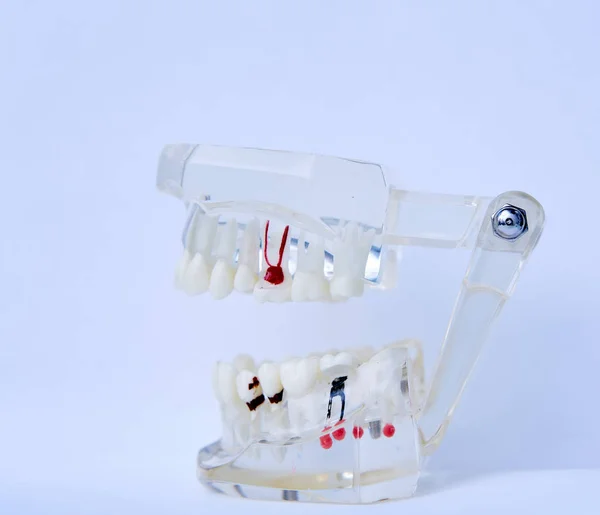 Dentists tooth plastic model with screw implant for teaching, learning and patients in dental office showing teeth and gums. — Stock Photo, Image