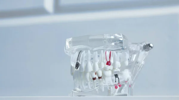 Close up of a Dental implant model. — Stock Photo, Image