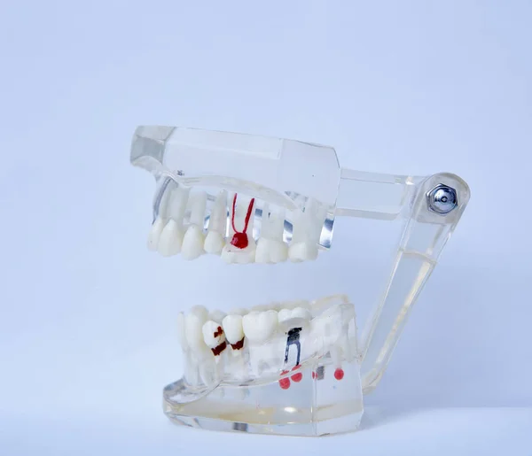 Close up of a Dental implant model. — Stock Photo, Image