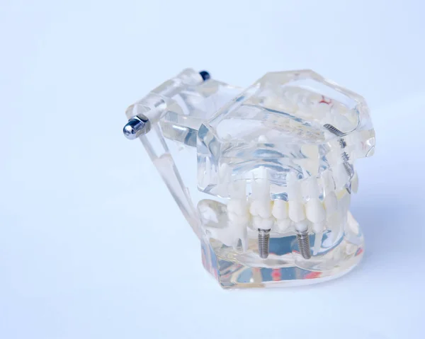 Close up van een tandheelkundig implantaat model. — Stockfoto