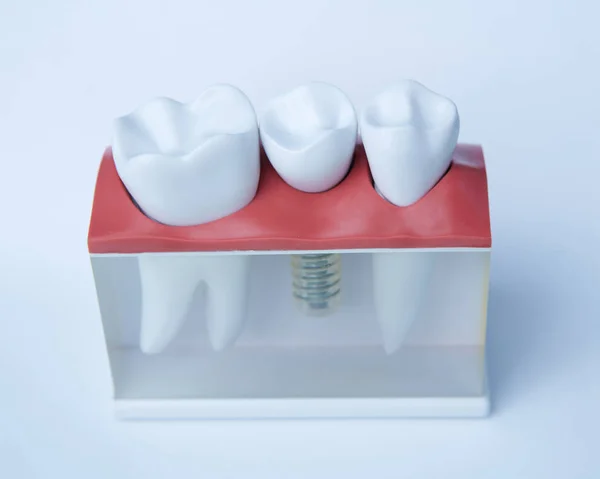 Zubaři zubní plastikový model s šroub implantát pro vyučování, učení a pacienti v zubní ordinaci, zuby a dásně. — Stock fotografie