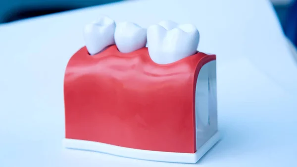 This model shows that teeth have been capped and the stainless pin in the gums. — Stock Photo, Image