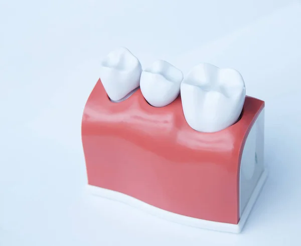 This model shows that teeth have been capped and the stainless pin in the gums. — Stock Photo, Image